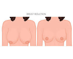 Breast Reducton
